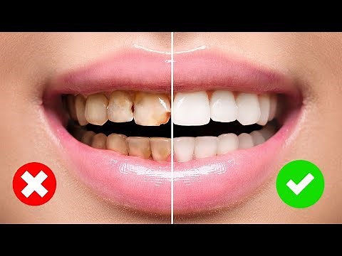 How To Remove Cavities From Teeth | Home Remedies
