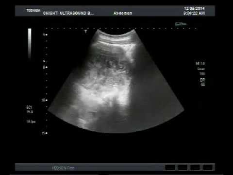 Ultrasound video of Worms ( Ascaris lumbricoides / Roundworm ) in the Gall Bladder.