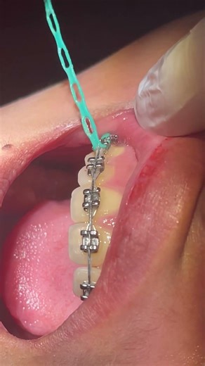 Change Ligatures #dentist #smiledesigndental #dentalfilling #dentalfilling #orthodontist