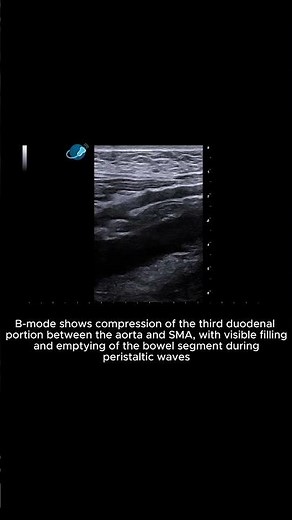 Bowel – Superior Mesenteric Artery (SMA) Syndrome – Clip 1 B-mode