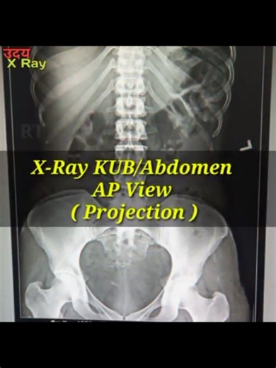 Understanding X-Ray KUB: Kidney and Urinary Tract Insights