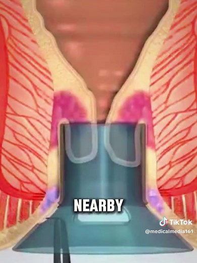 Pilonidal Sinus Treatment: Infection Removal & Recurrence Prevention