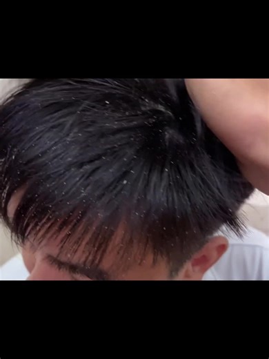 Scratching Dandruff