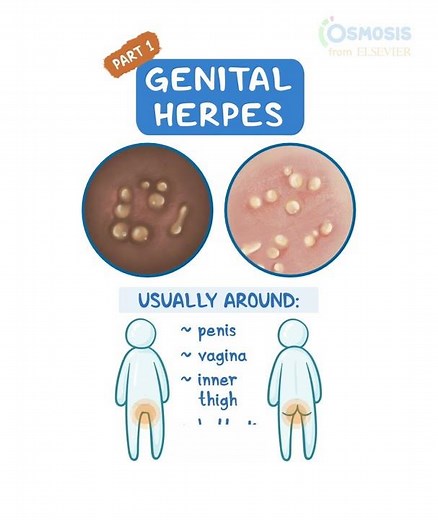 Genital Herpes
