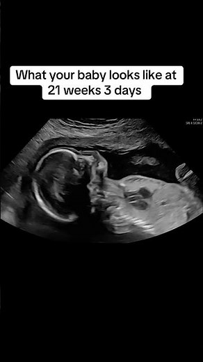 Anatomy scan 21 weeks #anatomyscan #21weeks #21weekspregnant #pregnancyjourney #ultrasound