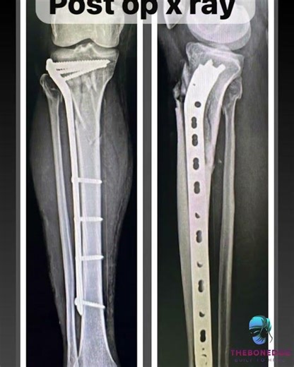 Shattered Tibia 😳 Can he walk again? | MIPO Plating Real Case Transformation 🔥” #orthopedics