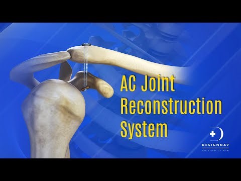 AC Joint Reconstruction System | 3D Medical Animation