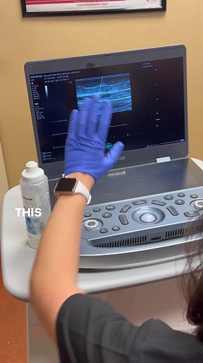 🔍 Ultrasound is the best way to evaluate and see which veins are working and not working. Watch as I show you the difference between a normal vein and an abnormal vein. 👩‍⚕️ At Nelson Vein, our expert team specializes in vein care, and we have state-of-the-art ultrasound equipment right here in-house. The best part? We read the ultrasounds as we perform them, so you don’t have to wait for results! We’re dedicated to your vein health and well-being. Say goodbye to varicose veins and hello to a 