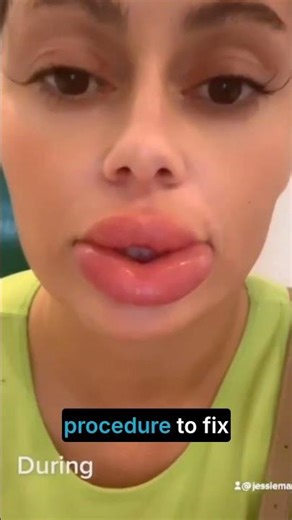 Dissolving Lip Filler: Hack or Damage Control?