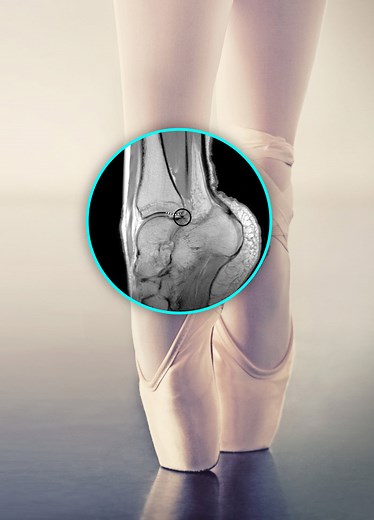 Do Ballerinas Really Stand On Their Toes? ( Long Term Effects ) - PostureInfoHub