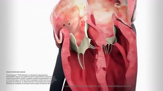 20、PFOClosurewiththeAmplatzer™PFOOccluder_高清1080P在线观看平台_腾讯视频