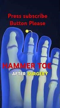 What is Hammer Toe? | Complete Guide with Treatment Options