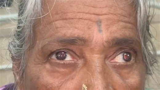 i_n_eye on Instagram: "WEBINO = Wall-Eyed Bilateral Internuclear Ophthalmoplegia Bilateral INO = Caused by bilateral medial longitudinal fasciculus (MLF) lesions Cause: Brain stem lesion Key clinical features • 👀 Primary position exotropia (“wall-eyed” appearance) • ❌ Adduction deficit in both eyes • ✔️ Abduction preserved • ☑️ abducting nystagmus (Due to increased innervational drive to overcome adduction weakness (Hering’s law), causing overaction of the abducting eye."