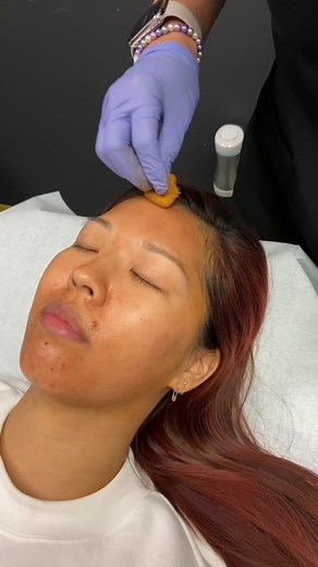 My First Medium Depth Chemical Peel Experience | VI Peel Precision Plus