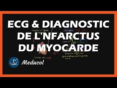 ECG et diagnostic de l'infarctus du myocarde (crise cardiaque)
