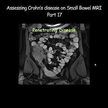 Assessing Crohn’s disease on Small Bowel MRI - Part 17 #radiology #crohnsdisease #crohnsandcolitis