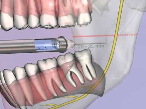 troncular anesthesia 3D