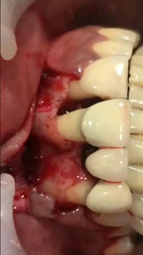 Gingival Flap Surgery
