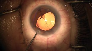 Malyugan Ring Insertion and Removal - Eyetube