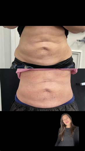 Body morpheus !! Follow my Ig for more ⚡️#greenscreen #morpheus #morpheus8 #aesthetic #nj #injector #fypシ