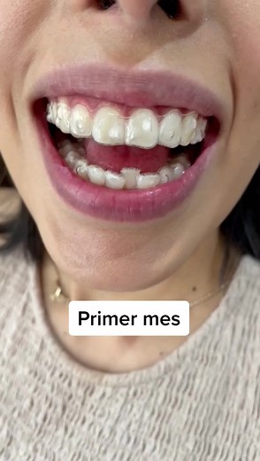 Así se ve mes con mes un tratamiento de ortodoncia con Invisalign 😍 #invisalign #ortodoncia #dentistasentiktok #sonrisa #foryou