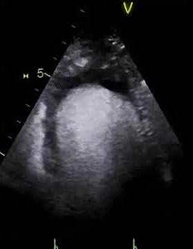Transthoracic Echocardiogram (TTE) With Definity Contrast