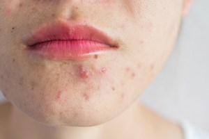 Faut-il percer ce petit bouton rouge ? Ce que dit une dermatologue
