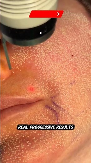 This CO2 Laser Is Changing Skin Forever | Real Results Frame by Frame