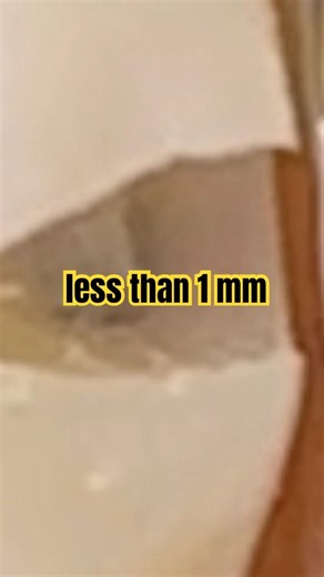 Class II Clearance 🦷 Most Students Get This Wrong!