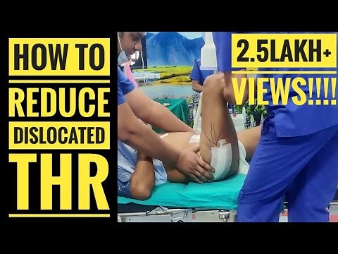 Reduction Technique for Posterior Hip Dislocation (THR)