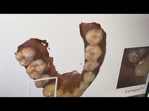 SCAN with 3Shape Wireless Scanner FOR ALIGNERS 🚨 | Delhi 5 Dental Clinic, Karol Bagh