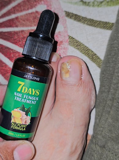 Understanding Fungus Nails: Causes and Treatments
