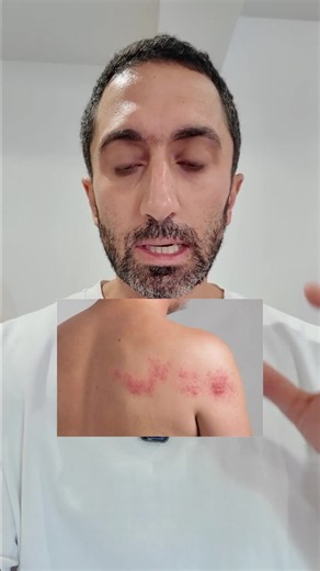 Le zona est une réactivation du virus varicelle-zona (VZV). Après une varicelle, le virus reste latent dans les ganglions nerveux et peut se réactiver des années plus tard, surtout avec l’âge ou en cas d’immunodépression. Il donne typiquement une douleur, des brûlures ou des paresthésies puis une éruption vésiculeuse unilatérale, suivant un dermatome. #zona