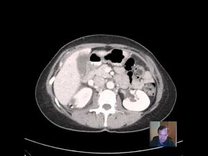CT Pyelonephritis DISCUSSION