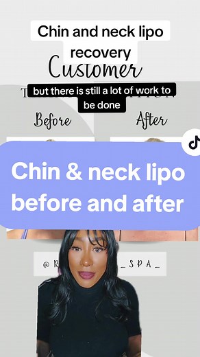Chin and neck lipo before and after. Lymphatic drainage after surgery is so important. If you have surgery booked, protect your investment with proper post-op care and lymphatic massages. #chinlipo #chinliposuction #chinliporecovery #necklipo #neckliposuction #neckliposculpting #liposuction #lipobeforeandafter #beforeandafter #compressiongarment #recoverytok #surgeryrecovery #austintx #austin