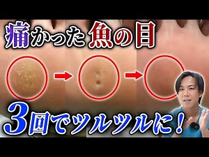 素足になる機会が多い夏に特に気になる魚の目の施術と予防方法