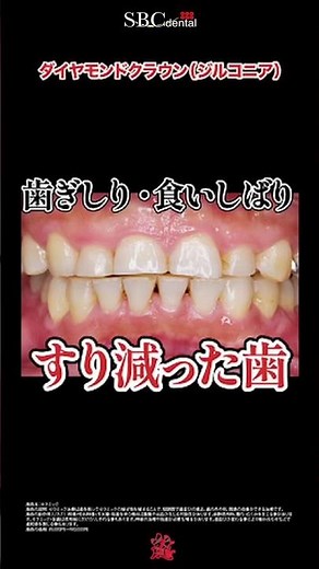 歯ぎしりによる歯のすり減りがお悩みでした。歯ぎしり自体の改善はナイトガードの使用やボツリヌス治療が効果的です#shorts #歯医者 #セラミック治療 #歯ぎしり