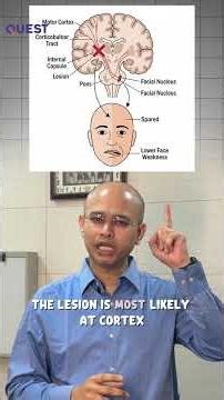 Bell’s Palsy vs. Stroke: How to Tell the Difference in 60 Seconds!