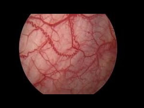 Cystoscopy with Hydrodistention for Interstitial Cystitis patients