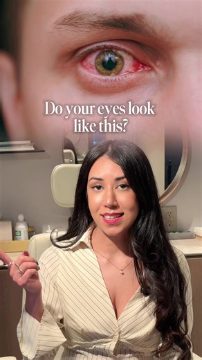 Whitening drops may make eyes look better temporarily — but they don’t address the reason your eyes are red. Persistent redness should be evaluated, not ignored. Call/text 646.791.6467 to schedule an eye exam. #fyp #eyes #doctor #eyedoctor #optometry