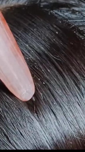 31K views · 189 reactions | Lice #lice #liceremoval #headlice | Lice Remove Reels | Facebook