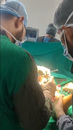 Open reduction and Fixation of Fibula with Closed reduction and Fixation of Tibia