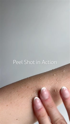 Peel Shot exfoliation before your eyes!! Love ‪@DRMelaxin‬ #drmelaxin #exfoliation #amazonfinds