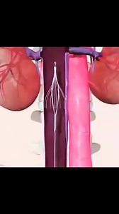 ⚠️ IVC filter . . Here is a clip of a IVC filter being inserted via the femoral vein route and placed in the inferior vena cava below the renal veins. . . The filter is placed in the inferior vena cava to catch any blood clots and prevent them from getting to the heart and lungs that would result in pulmonary embolism. . . ❤️Full video on the @cardiovisual app! . . #dvt #bloodclot #bloodclots #lunghealth #pulmonaryembolism #cardiac #nurse #nursestudent #studentnurse #cardiovascular #foamed #phys