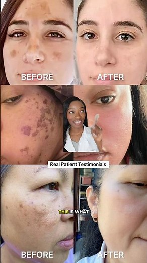 Musely Spot Cream: DARK SPOTS & HYPERPIGMENTATION | Hydroquinone & Tretinoin #Muselypartner