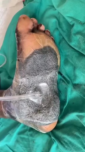 Negative Pressure Wound Therapy Explained