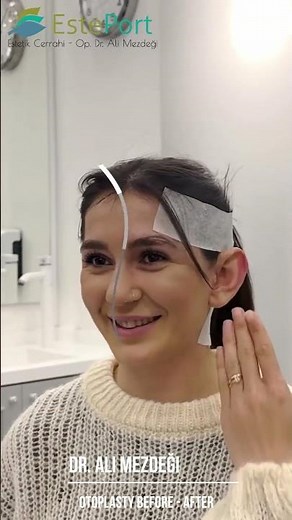 Ear Pinning Surgery Before & After | Amazing Transformation of a Young Girl