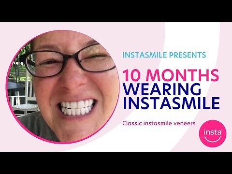 instasmile 10 month update | Clip on veneers | classic BL1 instasmile