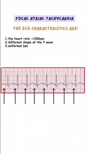 Focal Atrial Tachycardia #ecg #ecginterpretation #medicine #doctor #nurse