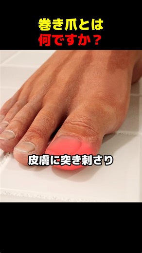 What is an ingrown toenail?